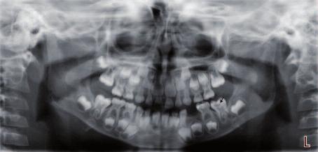 cunda her iki olgunun panoramik radyografilerinde, henüz sürmemiş olan sol alt birinci büyük azı dişinde mine-dentin sınırına komşu dentin dokusu içinde radyolüsent bir alan varlığı saptandı (Resim