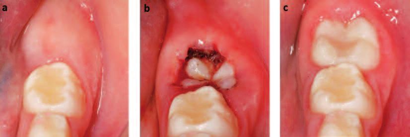 RESİM 6: a) Tedavi öncesinde, b) Tedavi için lazer ile açığa çıkartılmış, c) Altıncı ay kontrol seansında erüpsiyonu tamamlanmış daimi sol alt 1. molar dişe ait intraoral görüntüler (Olgu 2).