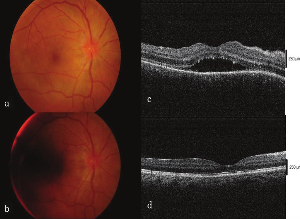 lezyonlarda hiperfloresans, solda foveada dekolmana bağlı göllenme görülmektedir (D). Çekilen de subfoveal seröz retina dekolmanı, sıvıda fibrinöz hiperreflektans mevcut (E).
