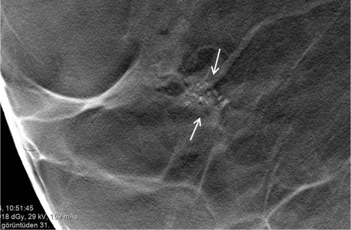 Segmental Diffüz 3 0 0 0 0 3 Bölgesel 0 12 3 0 1 16 Grup 0 0 6 0 0 6 Lineer 0 0 1 0 0 1 Segmental 0 0 0 0 8 8 Toplam 3 12 10 0 9 34 κ=0.