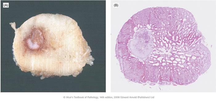 14 Şekil 2.7.Fibula yerleşimli osteoid osteoma aksiyel kesi gross patolojik görünümü ve H&E ile hazırlanmış mikroskopik görünümde iyi sınırlı nidus,çevresinde sklerotik odak izlenmekte [34].