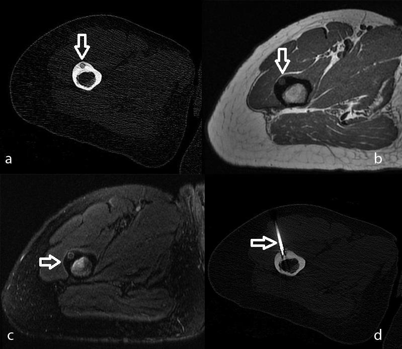 72 a. BT görüntüde intrakortikal yerleşimli santralinde kalsifik odağı izlenen nidus görünümü b. MRG T1 AG' de kasa göre hiperintens sinyal intensitesinde nidus görünümü c.