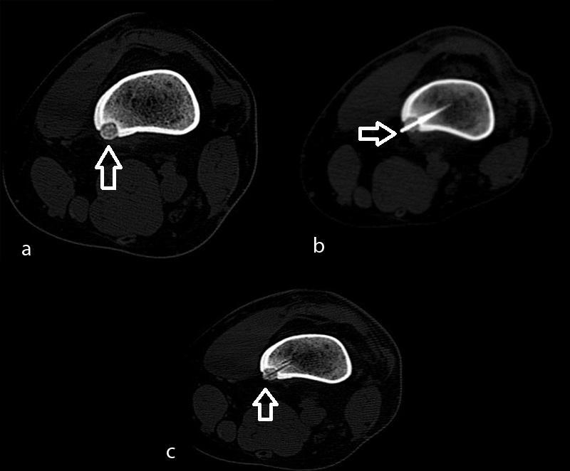 73 Olgu 2: 25 yaşında erkek, hasta; femur metafizinde intrakortikal osteoid osteoma olgusu; a. BT görüntüde femur metafizinde yerleşimli intrakortikal punktat kalsifiye nidus görünümü b.