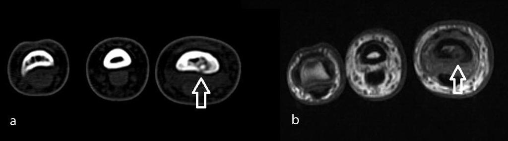 RFTA işlemi sırasında BT ile radyofrekans elektrodunun nidus santralinde olduğunu gösteren BT görüntüsü Olgu 4: 17 yaşında erkek,