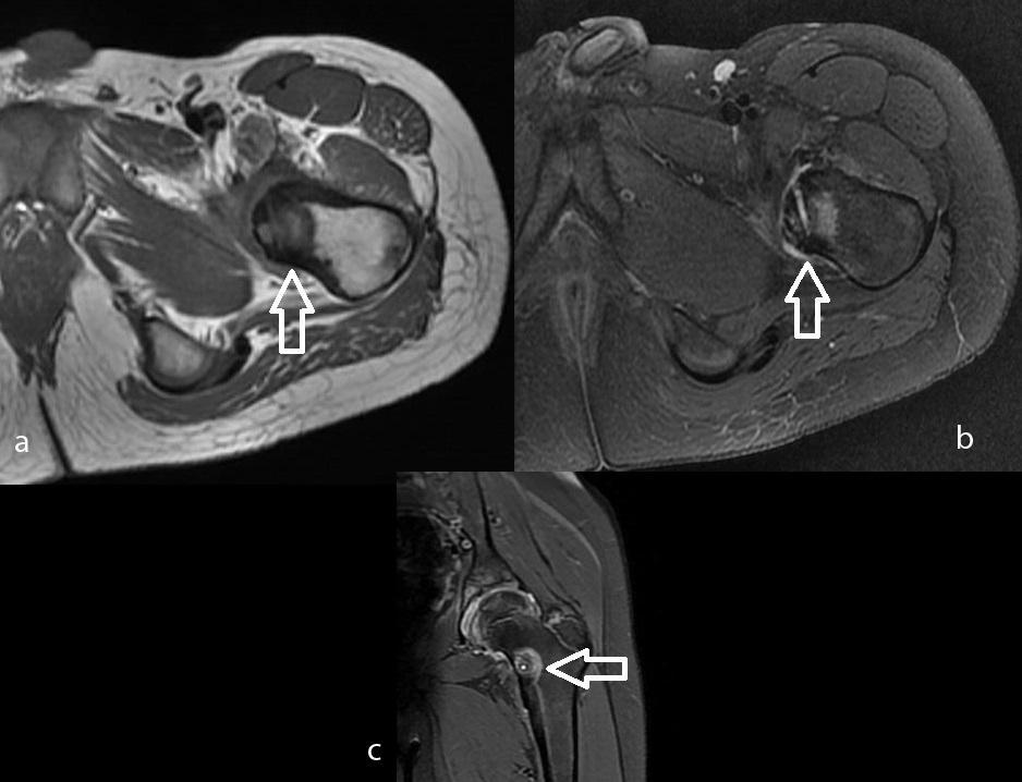 77 Olgu 6: 11 yaşında erkek, femur metafiz yerleşimli intrakortikal osteoid osteoma olgusu; a.