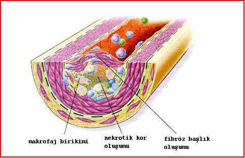 2. 2. 1. 4. Fibröz Balık (Fibrous Cap) Aterosklerozun kompleks plaklar haline dönümesinde düz kas hücreleri rol oynar.