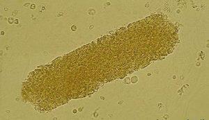 sıkıştığı toplayıcı tüpün şeklini almış Tamm-Horsfall mukoproteinidir. İçerisinde hücre görülmez, sediment de zor görülür.