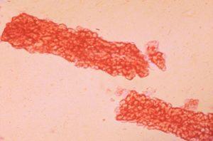 Fatty Yağlı Silendir Yağlı silendirler lipitten zengin epitel hücrelerin dejenerasyonu ile oluşurlar. Silendirin protein yapısı içerisinde yağ vakuolleri dikati çeker.