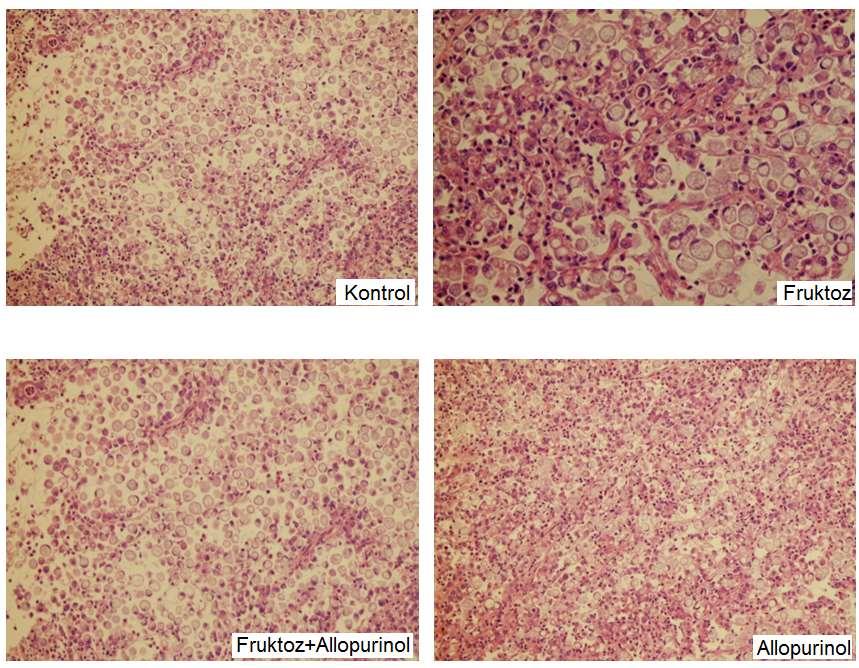 Kontrol: Normal histolojide karaciğer dokusu Fruktoz: Karaciğer hepatositlerinde hidropik şişme, nekroz ve orta derece portal