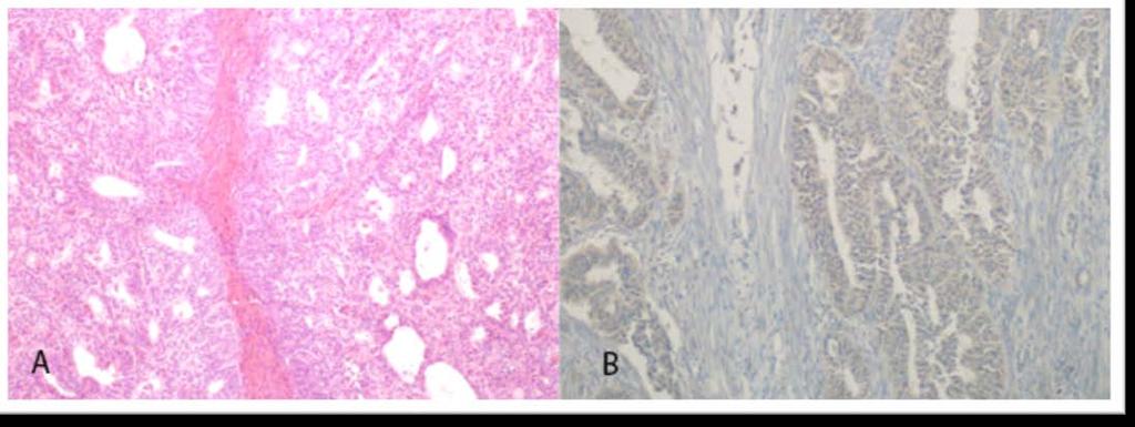 A: Derece 1 Endometrioid Adenokarsinom (H&E, X100) B: Derece