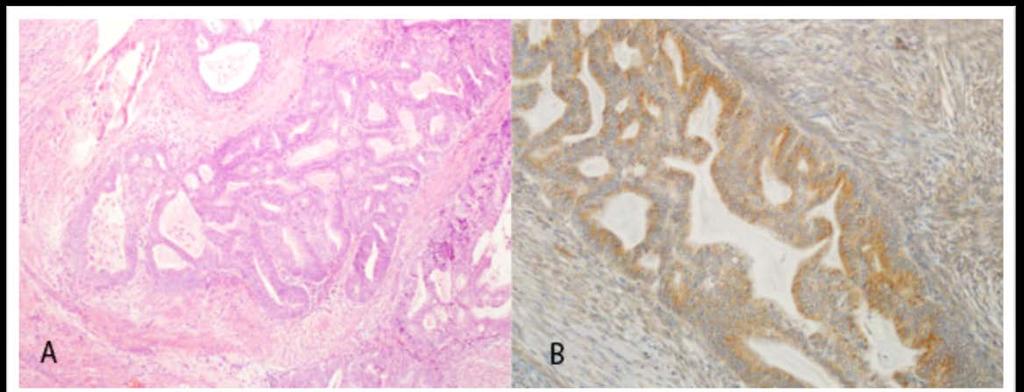 X200). A: Derece 1 Endometrioid Adenokarsinom (H&E, X100).