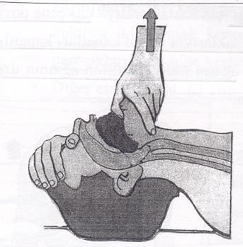 Üçlü manevra veya Çene ileride manevrası Çene ileride manevrası: Elin başparmağı kişinin ağzına konarak