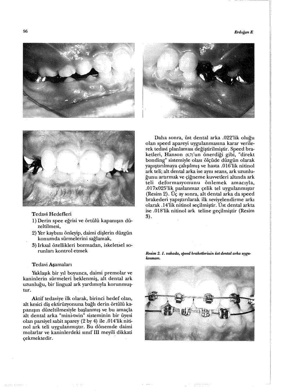 96 Erdoğan E Tedavi Hedefleri 1) Derin spee eğrisi ve örtülü kapanışın düzeltilmesi, 2) Yer kaybını önleyip, daimi dişlerin düzgün konumda sürmelerini sağlamak, 3) Irksal özellikleri bozmadan,