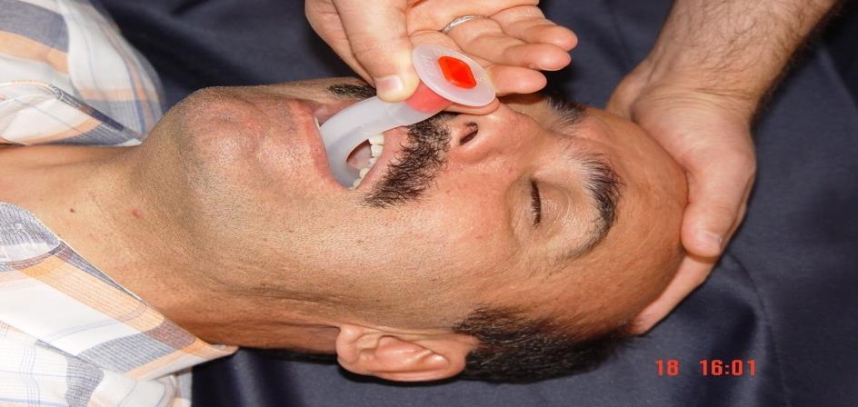 OROFARINGEAL AIRWAY Teknik: Hastanın ağzı açılır ve ağız içinde yabancı cisim, kan, kusmuk varsa