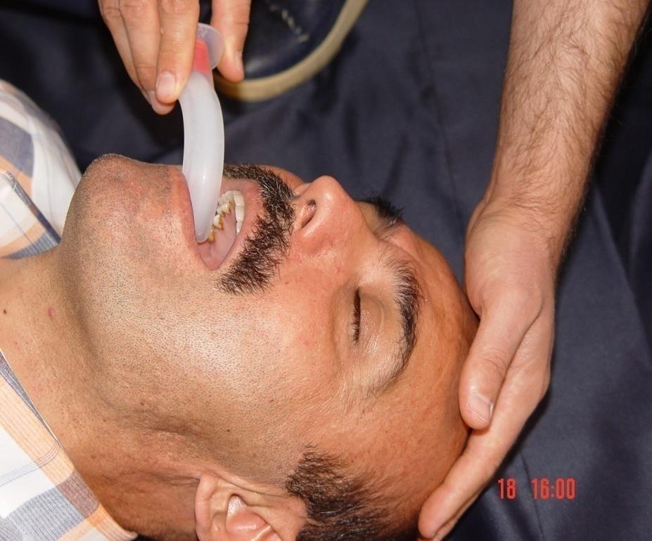 OROFARINGEAL AIRWAY