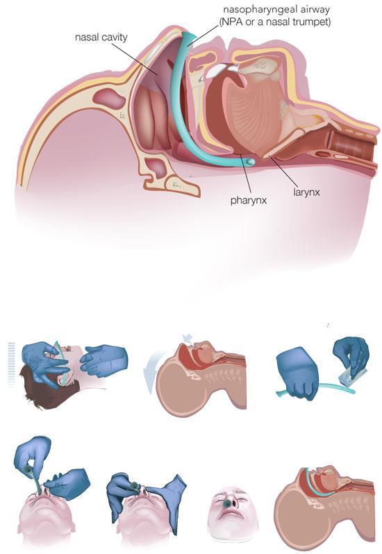 NAZOFARINGEAL AIRWAY Teknik: Uygun ölçüdeki tüpe kayganlaştırıcı sür Burundan yavaşça sok ve posterior farinkse doğru