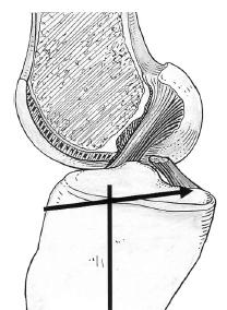 Şekil 21: Sagital planda yukarı doğru tibial eğim (149) Femur ve tibianın posteriorundaki büyük osteofitler de fleksiyon-ekstensiyon kısıtlılığına neden olabilir.