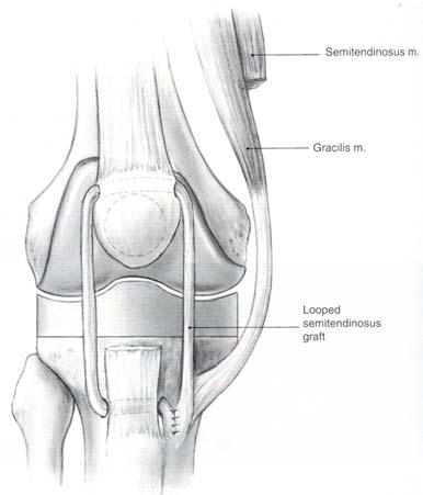 Patellar tendon rüptürü riski önceden diz ameliyatı geçirenlerde ve diz protezi sırasında eksposure için parsiyel patellar tendon gevşetmesi yapılanlarda fazladır.