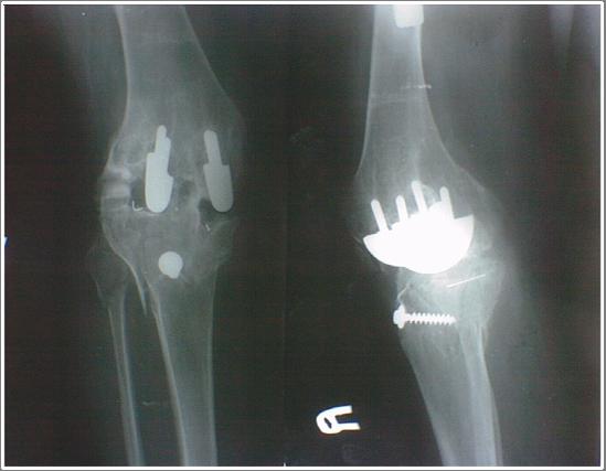 Şekil 2: Dr. Güngör Sami Çakırgil in uyguladığı diz protezi(9) Total diz artroplastisinin gelişiminde modern dönem 1970 li yıllarda başlamıştır. Bunun ilk öncüsü Total Kondiler Protez olmuştur.
