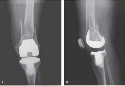 Total diz protezi sonrası olan suprakondiler femur kırıkları genellikle düşük enerjili travma sonrası oluşur.