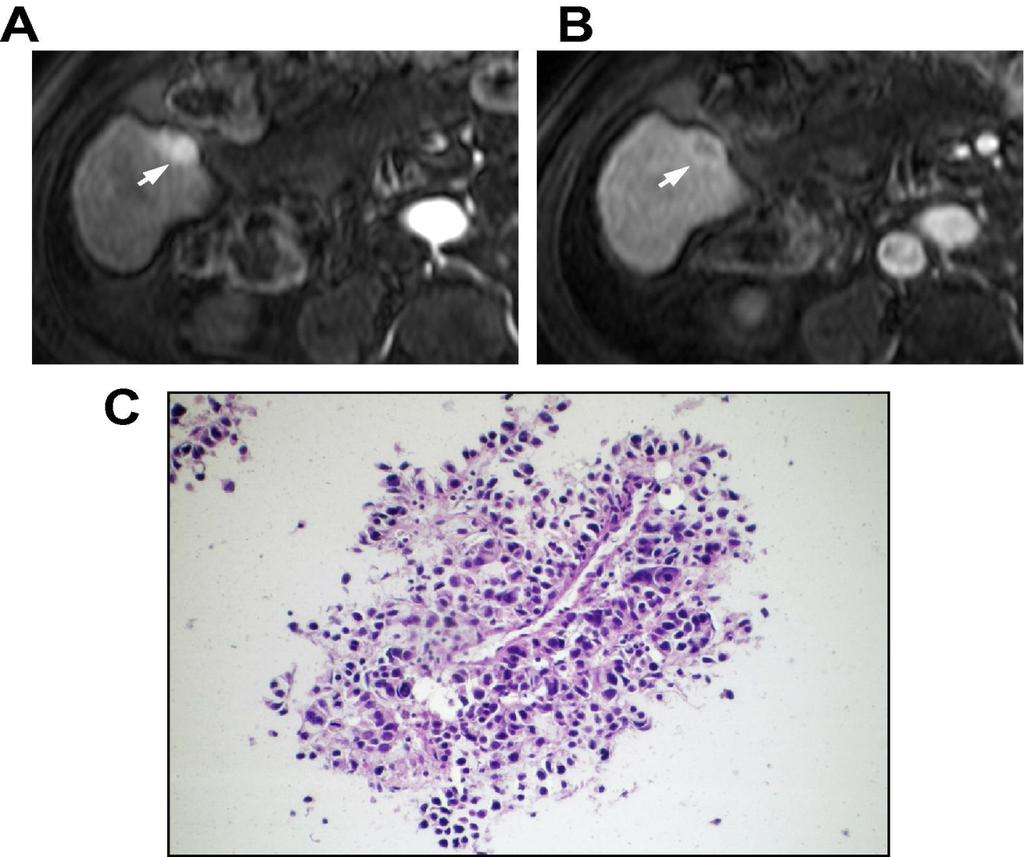 Fig. 3 False positive MRI findings for hepatocellular carcinoma.