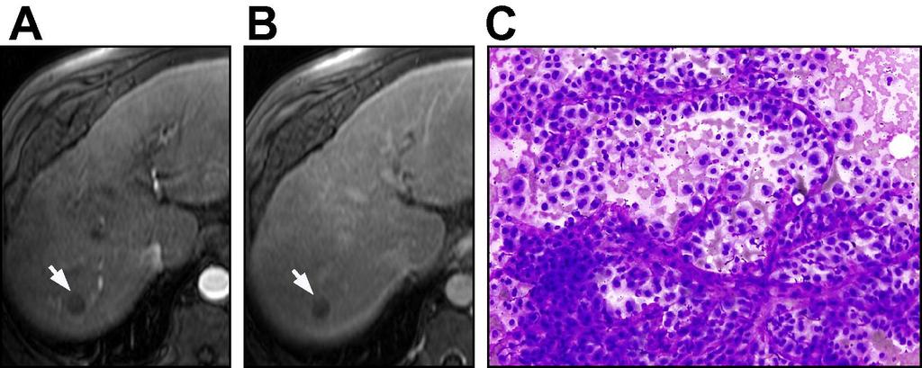 Fig. 4 Small (15mm) HCC: Atypical Vascular Pattern No enhancement either on arterial (A) or on the delayed phase (B) Histology (FNB) shows a well-differentiated HCC.
