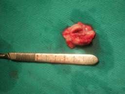 Resim 4. Total olarak çıkarılan tümöral kitle. Resim 5. a) Tümör eksizyonu ve boyun diseksiyonu sonrasında mandibulanın intra operatif görünümü.