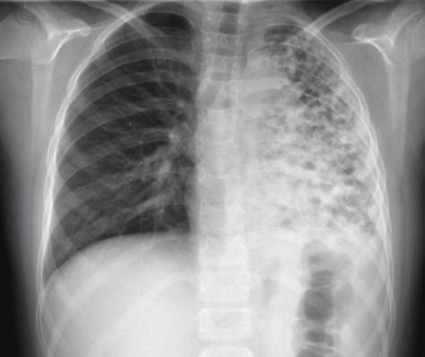 Mediastinal şift ve paradoksal diyafragmatik solunumu gösterir.