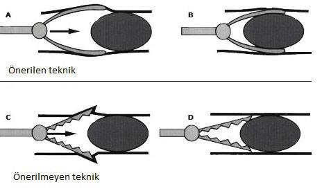 Kök A. 109 Resim 9. Yabancı cisim çıkarmak için önerilen tutma teknikleri ( 2018 UpToDate, Inc. and/or its affiliates). Resim 10. Forseps çeşitleri. alıp hemen rijit bronkoskopi yapılmalıdır.