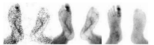 DM, E, 55y. Sağ ayak 1.parmakta lezyon. Lezyon alanında kronik travma mevcut. Osteomyelit?