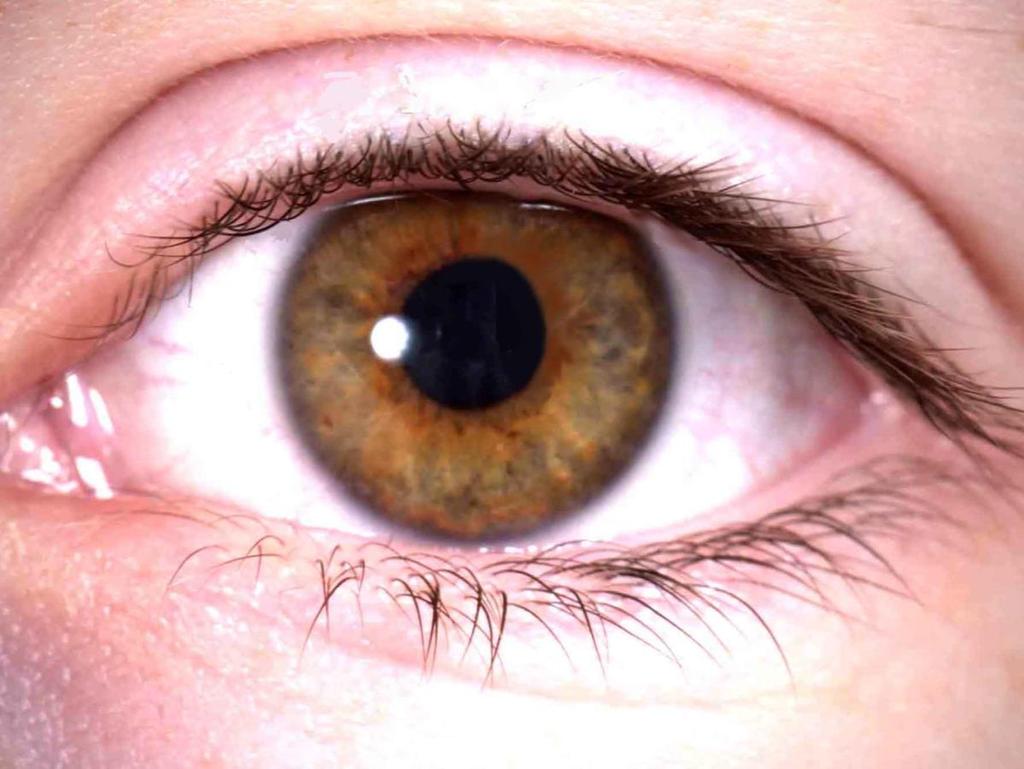 DM bağlı göz hastalıkları
