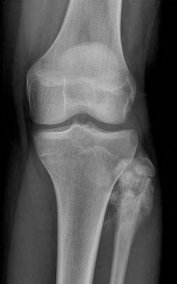 496 TOTBİD Dergisi (c) Şekil 5. a c. Fibula başı yerleşimli osteoblastik tipte osteosarkom.