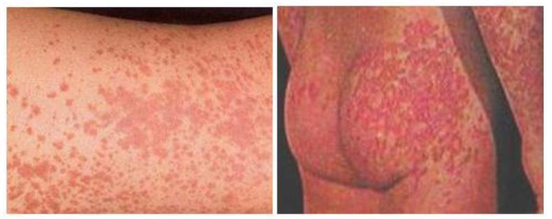 Enfeksiyon Hastalıklarında Önemli Dermatolojik Belirtiler Purpura: Eritrositlerin damar