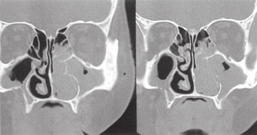İnverted Papillomada Cerrahi Tedavi Yaklaşımları 61 Resim 2. Ekstranazal (Lateral rinotomi) yaklaşımla medial maksillektomi planlanan bir olgunun preoperatif BT görüntüsü.