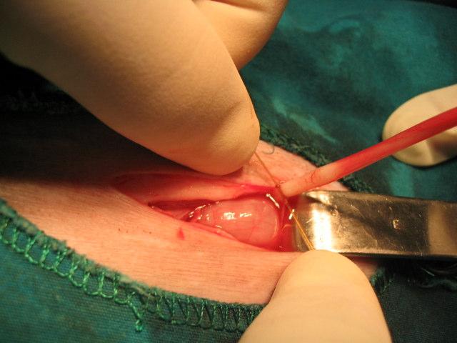 Corpus uteri nin diseksiyonu Şekil