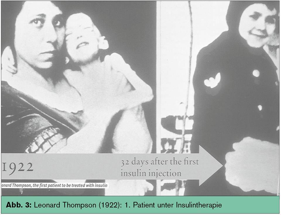 11 Ocak 1922 İnsülin tedavisine başladıktan 79 gün sonra Dr Ralph Major un hastası Billy Leroy;