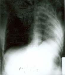 Resim 2. Olgunun operasyondan hemen sonraki akciğer Resim 4. Olgunun operasyondan 2 gün sonraki akciğer TARTIŞMA Resim 3.