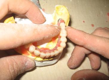 Üst sol birinci molar diģi, üst sol ikinci premolar diģin distaline yerleģtiriniz.