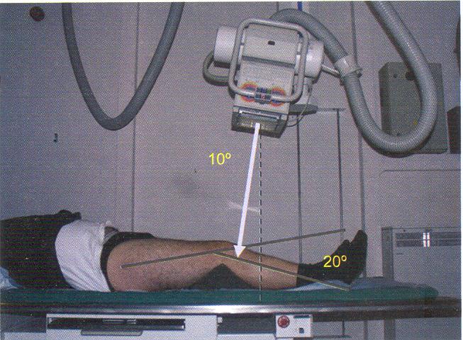 Teknik: Hasta, dizi 20 fleksiyona getirmek için koyulmuş bir destekle, röntgen masasının üstüne sırtüstü uzanır.
