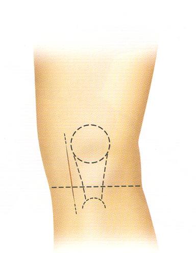 Paramedial cilt insizyonu patellanın medial kenarından başlayıp tibial tüberkülün medialinde eklem çizgisinin 3 cm distaline uzanır(şekil 2.8.2). İnsizyon eklem kapsülüne kadar derinleştirilir.