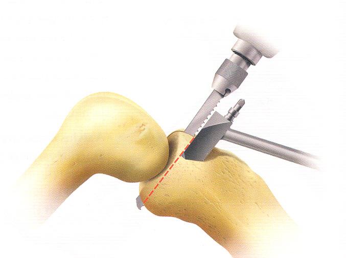 Testere tibia platosunun arkasına uzanmalı ve biraz geçmelidir. Vertikal testere kesisi testere kılavuzunun üst yüzeyine kadar inmelidir(şekil 2.8.