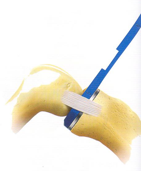 Tibial deneme ve 4 mm kalınlık ölçücü yerleştirilerek yeterli kemik eksizyonu yapılıp yapılmadığı kontrol edilir(şekil 2.8.9).