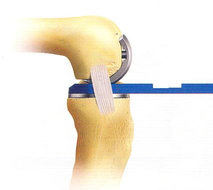 90 lik fleksiyona sahip bacağa tibial deneme takılır ve femoral deneme komponenti, femoral aksa 45 açıyla çakılır.