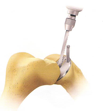 üçüncü oblik testere kesisi eburne kemiğin çıkartılmasını kolaylaştırır. Kesiklerin 1 cm den daha derin olmamasına özen gösterilir. Şekil 2.8.