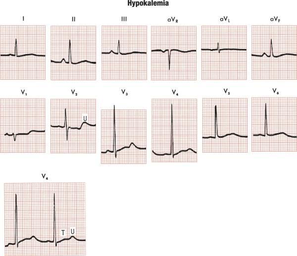 HİPOKALEMİ- ekg U dalgası ST depresyonu T dalgasında