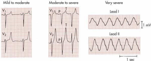 HİPERKALEMİ- ekg T dalgasının sivrileşmesi P dalgasının düzleşmesi PR