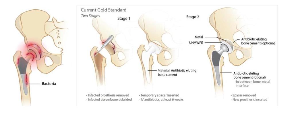 Schematic of the current gold-standard treatment of patients with periprosthetic joint infection.