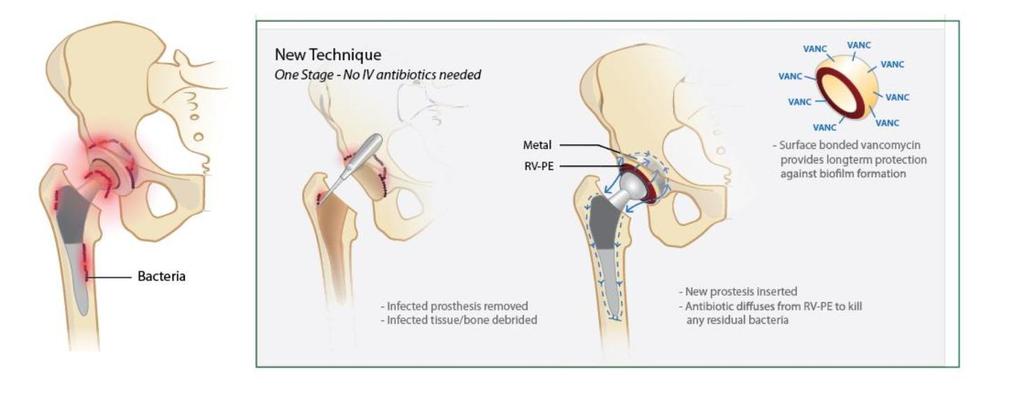 Schematic of our proposed treatment of patients with periprosthetic joint infection using our new material.