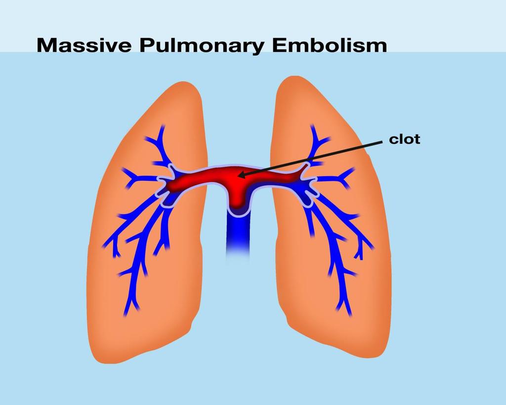 Pulmoner