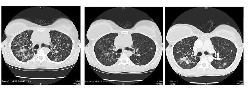 Mut (+) NSCLC-EGFR TKI KazanılmıĢ Rezistans Bazal